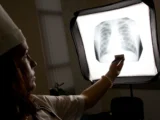 Wydłużenie programu leczenia gruźlicy wielolekoopornej: co to oznacza?